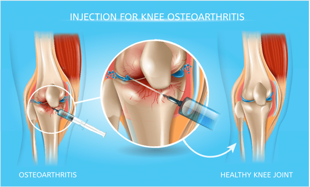 Meta-Analysis Examines Treatments for Knee Osteoarthritis